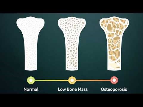 All About Health - Understanding Bone Density: What Does the T-Score Mean? (大愛醫生館 - 判讀骨鬆)