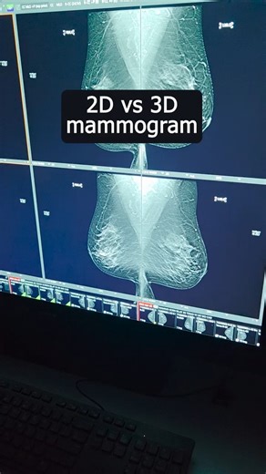 There's quite a difference between 2D and 3D mammograms! Here's how a diagnostic radiologist reviews the different scans and what they're looking for. | Mercy Hospital Fort Smith