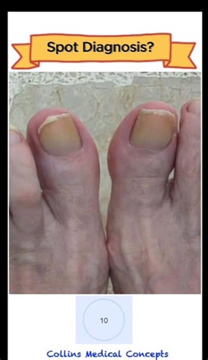 SPOT DIAGNOSIS #12: Why Are These Toenails Yellow? #medicalquiz