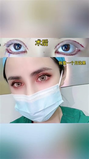 One month after double eyelid surgery#双眼皮 #doubleeyelidsurgery