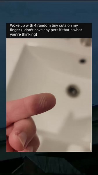 Random Cuts on Skin: Understanding the Tiny Unknown Scary Phenomenon