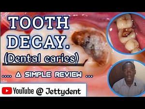 Tooth Decay(Dental Caries); A simple review. Causes, Types, Classifications, Prevention & Solutions