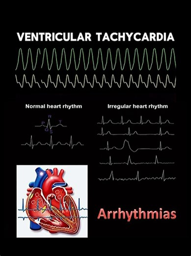 🫀 Understanding the Rhythm of Life ​Ever wondered what those lines on a hospital monitor actually mean? Here is a quick guide to the most common heart rhythms: ​Normal Sinus Rhythm: A steady, healthy beat between 60 to 100 bpm. ​Ventricular Tachycardia: The heart is beating dangerously fast. ​Ventricular Fibrillation: The heart is quivering instead of pumping—a major emergency. ​Asystole: Also known as a