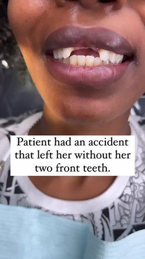 Losing two front teeth can be a devastating experience, especially when it happens in an accident. That's why when this patient came to us needing to replace her missing teeth, we immediately began working on a solution. Unfortunately, she was told that implants weren't an option and that a bridge wouldn't allow her to keep her beloved gap. It would have been easy for her to give up hope on ever getting her smile back. But then she found us. After careful evaluation, we were able to come up with