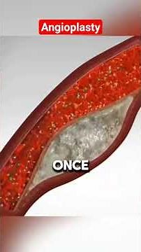 Coronary Angioplasty Explained