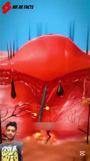 How does your body push a splinter out?"😱