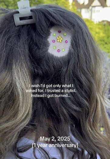 Horror Story: 3rd Degree Burn at a Salon