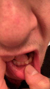 is this too much mobility? I know your teeth are supposed to somewhat move, but now im scared to put my invisalign back in..