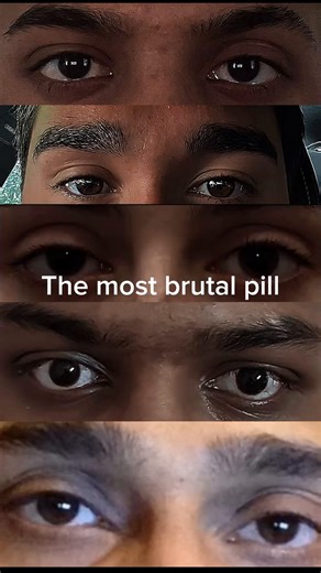 Surgery ain’t fixing this one #eyes #genetics #bp #itsover | eyes