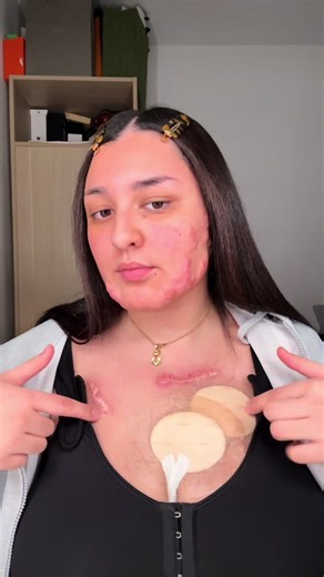 Mon deuxième rendez-vous post-op : J'avance vers la guérison