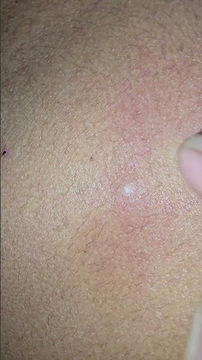 Sebaceous cyst Punctum