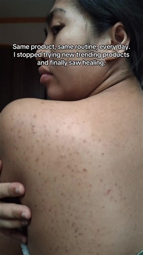 Effective Acne Treatment with Tea Tree and AHA