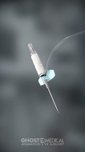 DeltaVen® is a multi-lumen central venous catheter designed for use in #hemodialysis, a medical treatment used to remove waste and extra fluid from the blood of patients with #kidneyfailure. Its design allows healthcare providers to administer medications and fluids while also providing access to the patient's bloodstream for the hemodialysis machine. DeltaVen® is specifically optimized for use in hemodialysis, with features that make it easier to perform multiple procedures simultaneously and r