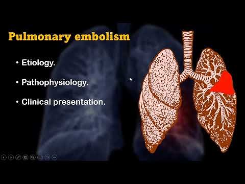 Pulmonary embolism: diagnostic workup and management guidelines
