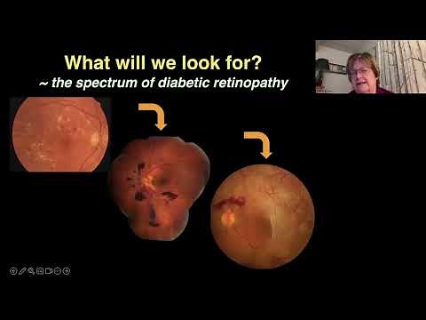 Lecture: Screening & Referral for Diabetic Retinopathy