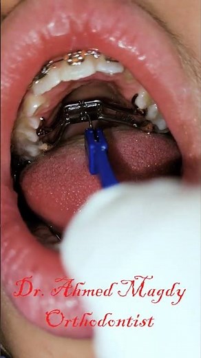 hyrax expander activation - Dr. Ahmed Magdy