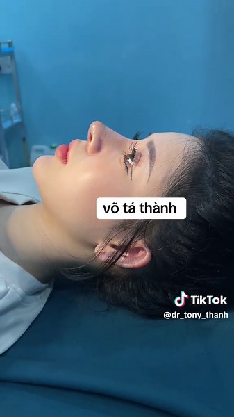 from mũi 10 ngày cắt chỉ #tonythanh #muicaotay #mui #nose #lamdep #thammy