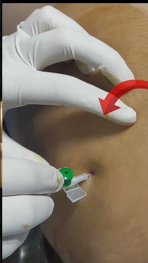 Ascites #ascites #waterbelly #livercirrhosis #heartfailureawareness