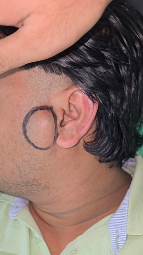 Sebaceous cyst | Dr Khaled's Tumour Helpline