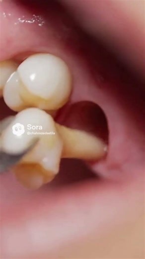 Safe Tooth Extraction #shortvideo