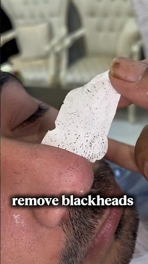 remove blackheads on nose: Ultimate 5-Minute At-Home Guide 2025}#barbershop