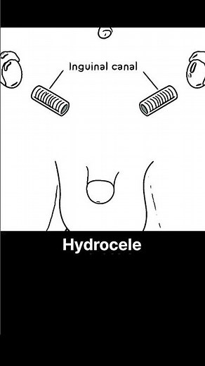 Hydrocele | خصیوں میں پانی پڑنا | Dr.AHMandal