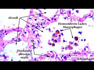 Hemosiderin Laden Macrophages ; Definition, Causes, Function, Detection, Clinical significance