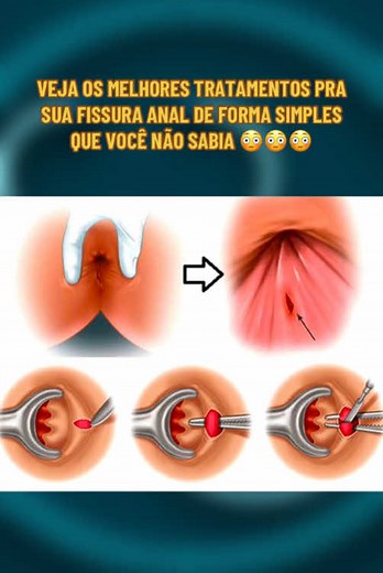 Tratamentos Eficazes para Fissura Anal Que Você Não Sabia