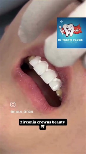 Veneer#viral #trendingshorts #duet #health #love #vlog #dentaltreatment#world #new #shorts#cute #lol