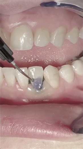 Class V composite restoration for lower lateral incisor tooth #dentistry
