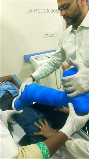Above knee fiberglass cast for tibia fracture #cast #fracture #plaster #fiberglass #ortho