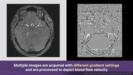 16_What is Phase-Contrast Magnetic Resonance Angiography (MRA)？ - MRI explained