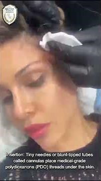 Fox Eye PDO Thread Lift step-by-Step Procedure | Lift, Define, Mesmerize! ✨