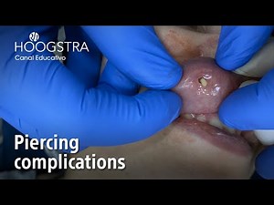 Piercing complications - 22193