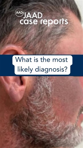 JAAD Journals on Instagram: "Which of the following is the most likely diagnosis? A: Hemosiderosis B: Postinflammatory hyperpigmentation C: Lichen planus pigmentosus D: Kratom-induced hyperpigmentation E: Erythema dyschromicum perstans Tell us your answer in the comments and find out through the link in bio."