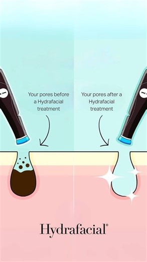 ALYSSAWIENS | Beauty Biz Mentor ✨ on Instagram: "✨ HydraFacial, step by step ✨ From deep cleanse ➝ gentle exfoliation ➝ painless extractions ➝ intense hydration 💦 Every step is designed to clear congestion, flood the skin with nutrients, and leave you with that instant glow This is why HydraFacial is a client favourite — results you can see and skin that feels clean, smooth, and refreshed Glowing skin starts here ✨ MSG me your questions or book an appointment online #hydrafacial #vernonhydrafac