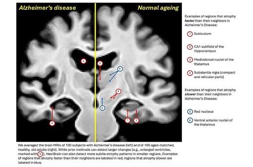 New brain atlas offers unprecedented detail in MRI scans