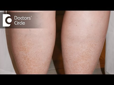 What causes lower leg swelling in women after 40's? - Kiran Sundara Murthy