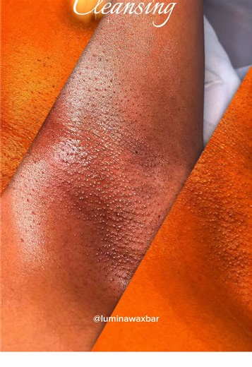 Gentle Sugaring Hair Removal for Sensitive Skin