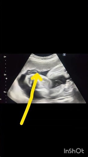 Pregnancy Ultrasound showing anterior Placenta! Placenta position ultrasound!#ultrasoundmadeeasy86