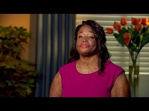 Boyfriend Threw Acid on Woman's Face When She Tried Breaking Up with Him