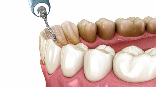 Scaling & Root Planing