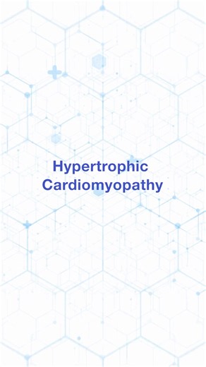 Hypertrophic cardiomyopathy can be difficult to diagnose. New research aims to help clinicians better identify high-risk patients, supporting earlier diagnosis, earlier treatment and better outcomes. Watch to learn how this work could make a difference for patients. #HypertrophicCardiomyopathy #HCM #Cardiology #MedicalResearch #PatientCare