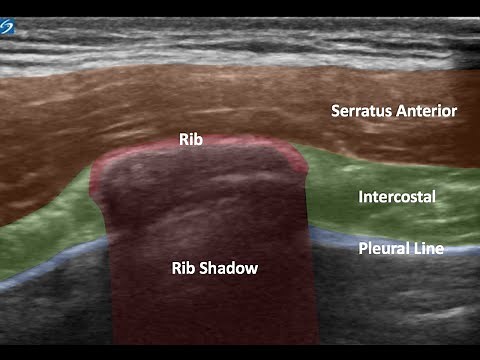 Serratus Anterior block for rib fracture pain management. 4/2021