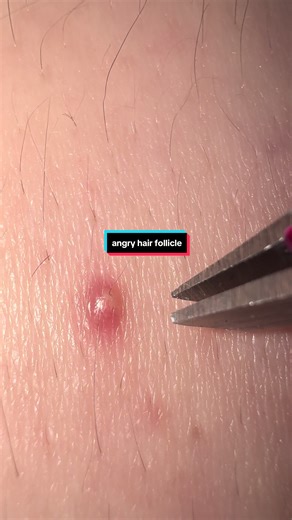 Effective Solutions for Ingrown Hair and Acne