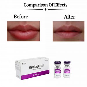 [Hot Item] Liporase Dissolve Hyaluronic Acid Hyaluronidase Liporase Injection Lipolab to Remove Fillers Hyaluronidase Liporase Injection Filler Dissolver