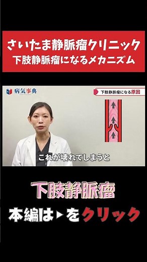 【下肢静脈瘤】下肢静脈瘤になるメカニズム #下肢静脈瘤 #足がつる #こむら返り