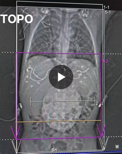 #siemens #somaton #force #cardiacct #congenitalanomalies #pediatriccardiology #radiologylife #ctimaging #medicalimaging #rarecase #siemens #ct #siemenshealthneers | Vaibhav Gurav