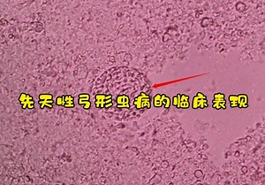 先天性弓形虫病的临床表现