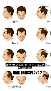 How Many Grafts Do You Really Need for a Hair Transplant? #shorts